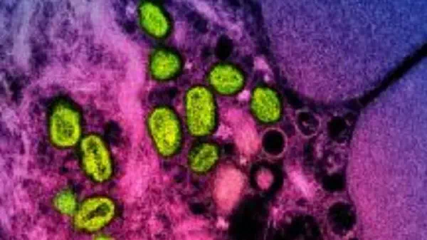 „Affenpocken“ - Neue Mpox-Variante: Jetzt erster Fall in der EU