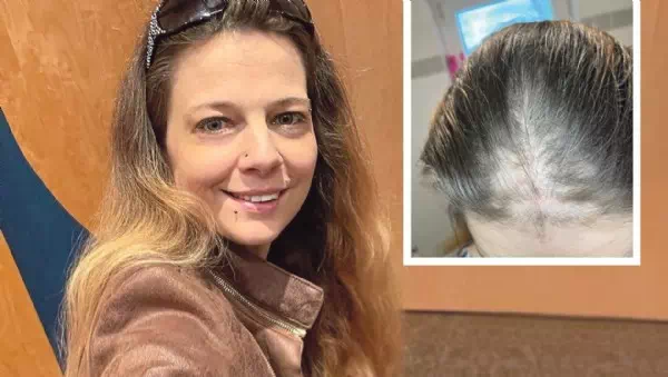 Große Ratgeberserie - Betroffene und Hilfe: Wenn Haare akut ausfallen