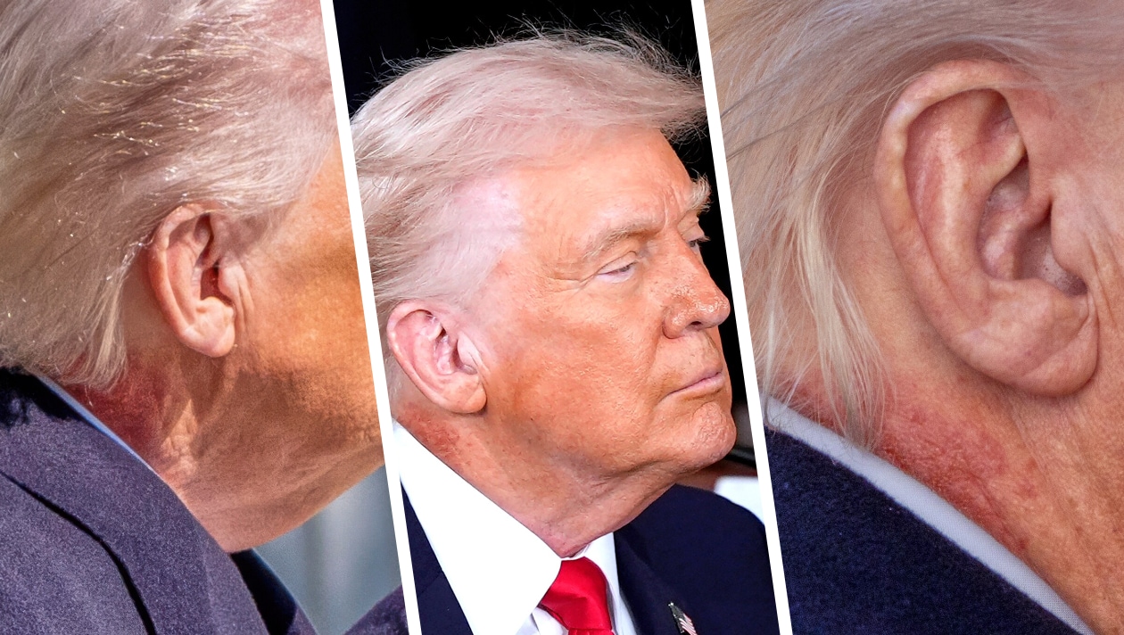 „Trump's mysteriöser Ausschlag sorgt für Spekulationen“