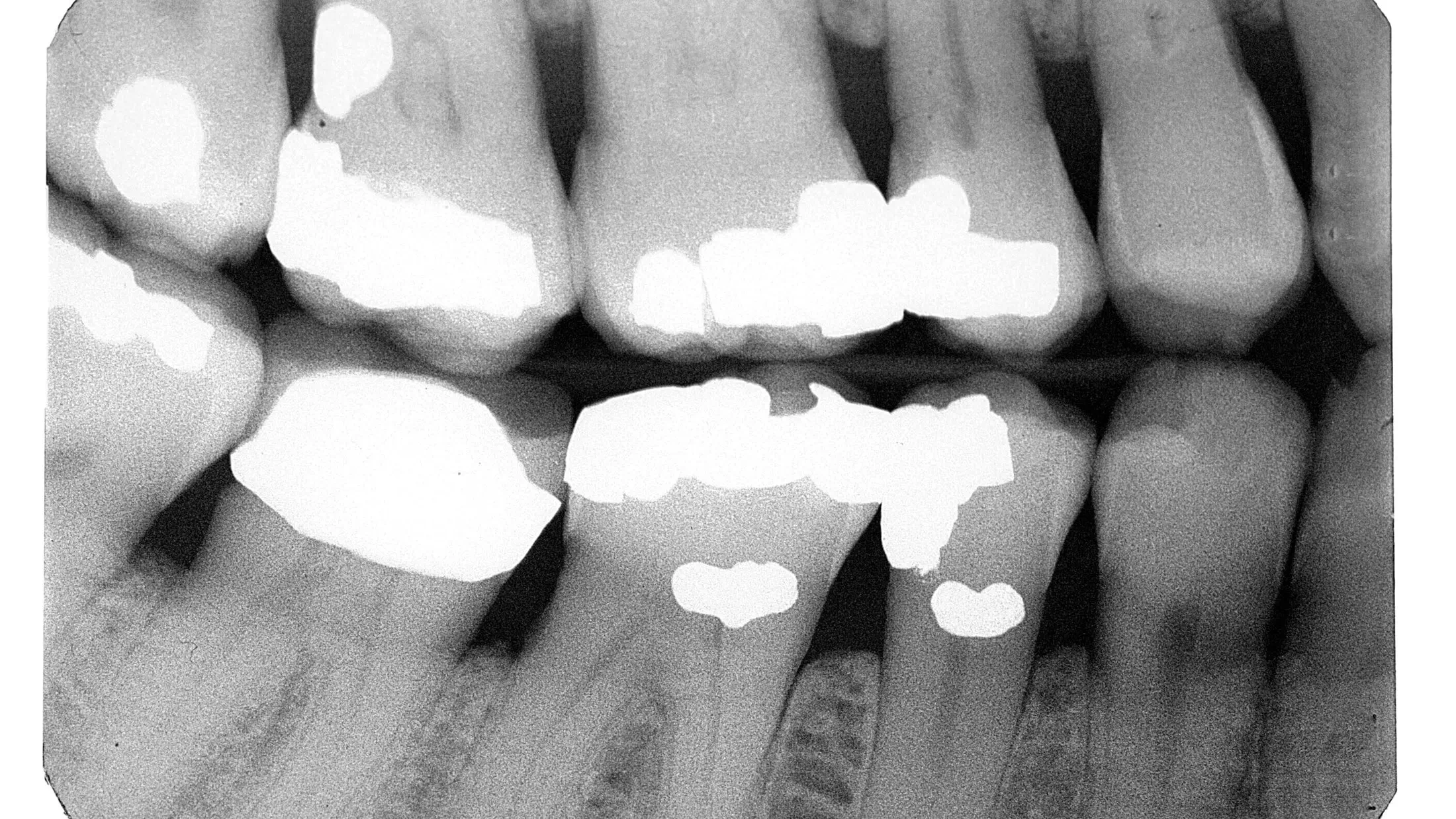 Verbot von Amalgam: Treffen der ÖGK abgesagt